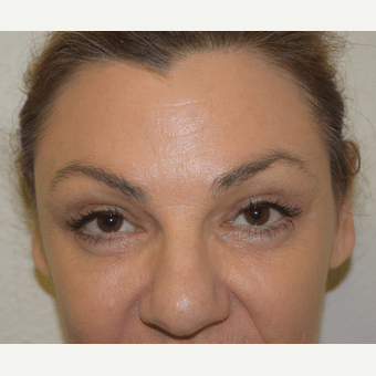 After Image: Eyelid Surgery - front