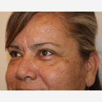 After Image: Eyelid Surgery - left-front-oblique