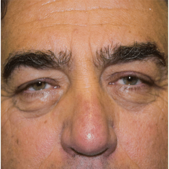 Before Image: Eyelid Surgery - front