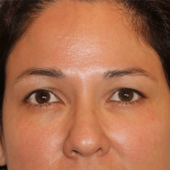 Before Image: Eyelid Surgery - front