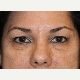 Before Image: Eyelid Surgery - front