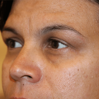 Before Image: Eyelid Surgery - left-front-oblique