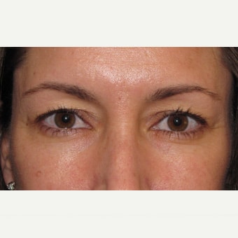 Before Image: Eyelid Surgery - front