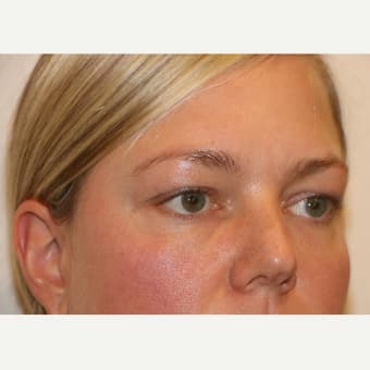 Before Image: Eyelid Surgery - right-front-oblique