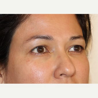 Before Image: Eyelid Surgery - right-front-oblique