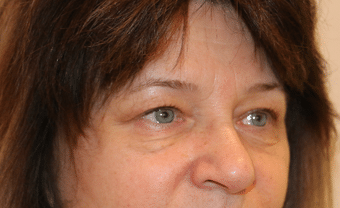 Before Image: Eyelid Surgery - right-front-oblique