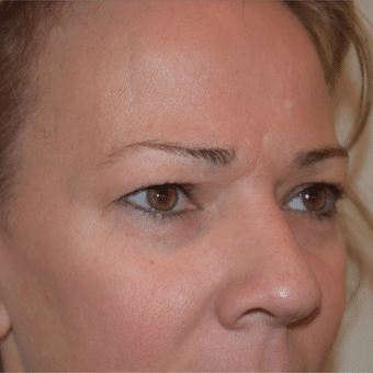 Before Image: Eyelid Surgery - right-front-oblique