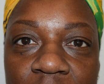Before Image: Eyelid Surgery - front
