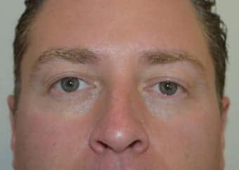 Before Image: Eyelid Surgery - front