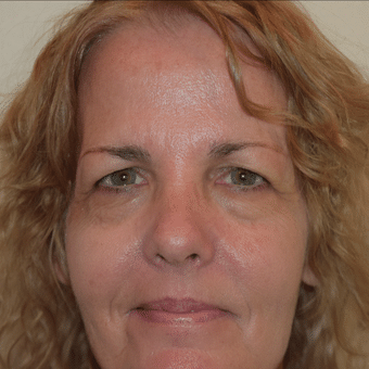 Before Image: Eyelid Surgery - front