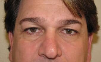 Before Image: Eyelid Surgery - front