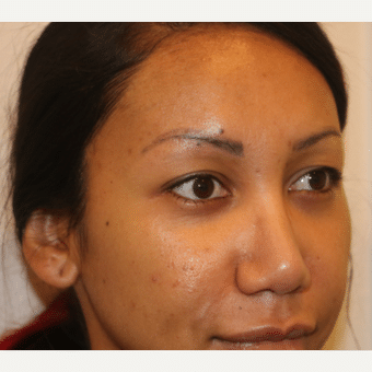 Before Image: Eyelid Surgery - right-front-oblique
