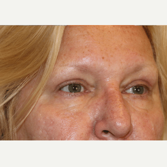 After Image: Eyelid Surgery - right-front-oblique