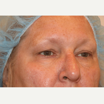 Before Image: Eyelid Surgery - right-front-oblique