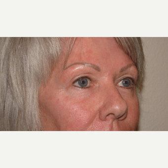 Before Image: Eyelid Surgery - right-front-oblique