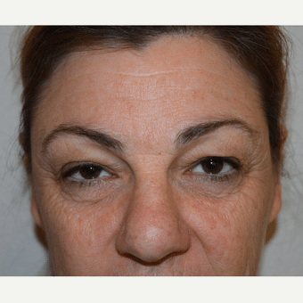 Before Image: Eyelid Surgery - front