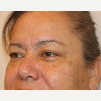 Before Image: Eyelid Surgery - left-front-oblique