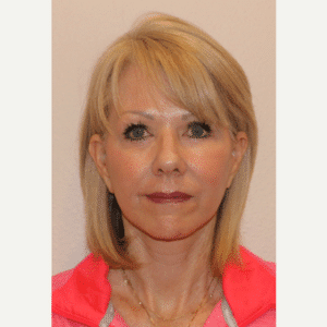 After Image: Facelift