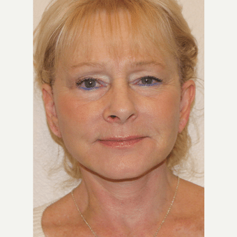 After Image: Facelift - front