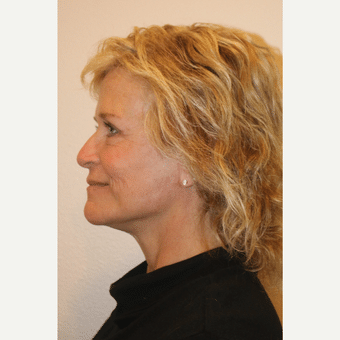 After Image: Facelift - left-side