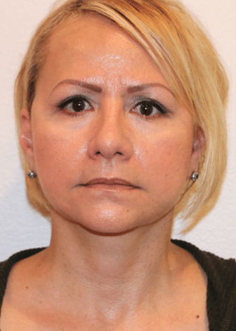 After Image: Facelift - front