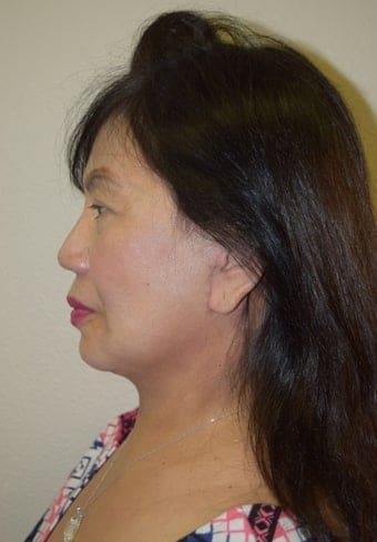 After Image: Facelift - left-side