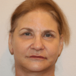 After Image: Facelift