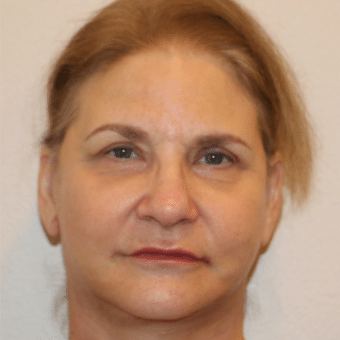 After Image: Facelift - front