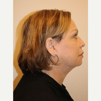After Image: Facelift - right-side