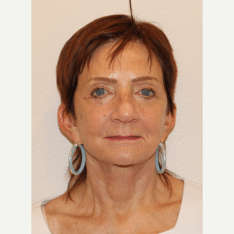 After Image: Facelift - front