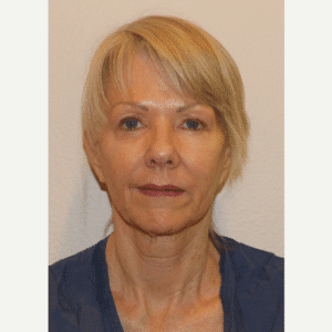 Before Image: Facelift