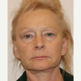 Before Image: Facelift - front