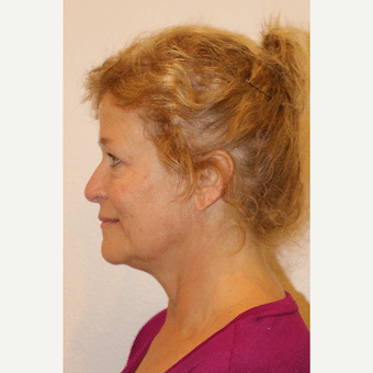 Before Image: Facelift - left-side