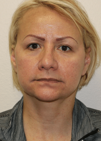 Before Image: Facelift - front