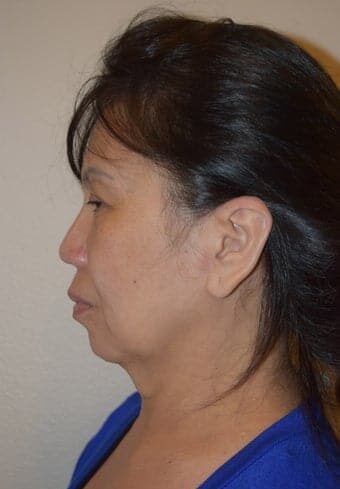 Before Image: Facelift - left-side