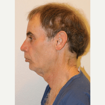 Before Image: Facelift - left-side