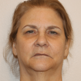 Before Image: Facelift - front