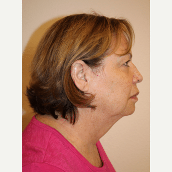 Before Image: Facelift - right-side