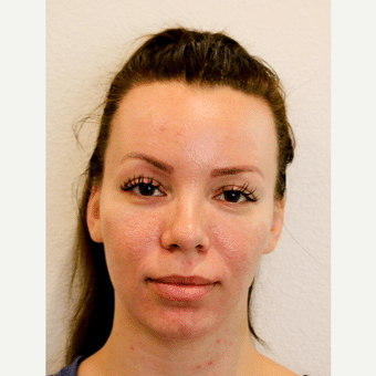 Before Image: Forehead Reduction - front
