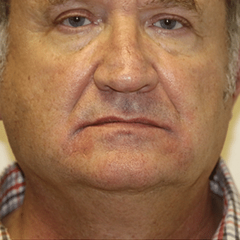 After Image: Injectable Fillers - front