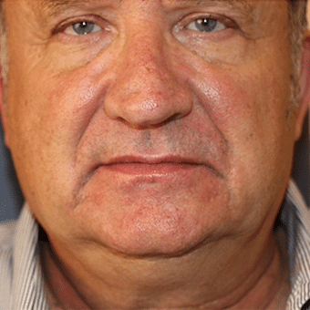 Before Image: Injectable Fillers - front