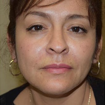 After Image: Juvederm - front