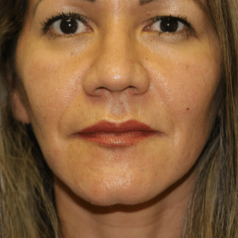 After Image: Juvederm - front