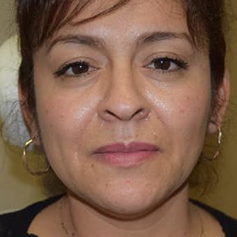 Before Image: Juvederm - front