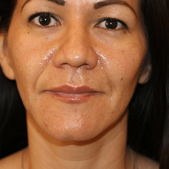 Before Image: Juvederm - front