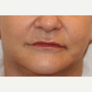 After Image: Lip Augmentation