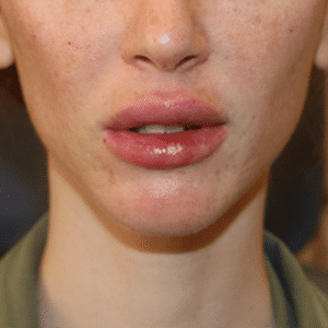 After Image: Lip Augmentation