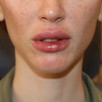After Image: Lip Augmentation - front