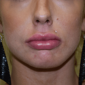 After Image: Lip Augmentation