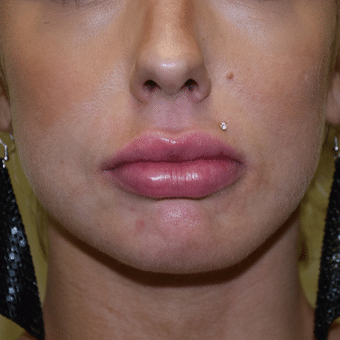 After Image: Lip Augmentation - front